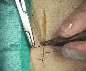 医疗缝线怎么做做手术时，伤口是这样缝的~_https://www.jmylbn.com_新闻资讯_第3张