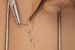 医疗缝线怎么做做手术时，伤口是这样缝的~_https://www.jmylbn.com_新闻资讯_第5张