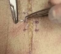 医疗缝线怎么做做手术时，伤口是这样缝的~_https://www.jmylbn.com_新闻资讯_第8张