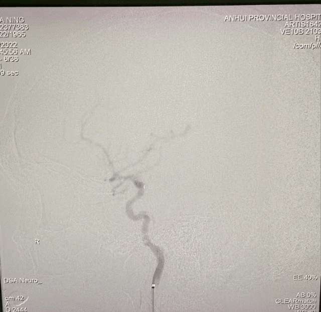什么达医畅疗·第一期 ｜ 畅医达（Choydar）17小系统血流导向装置治疗大脑中动脉动脉瘤两例_https://www.jmylbn.com_新闻资讯_第26张