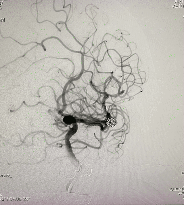 什么达医畅疗·第一期 ｜ 畅医达（Choydar）17小系统血流导向装置治疗大脑中动脉动脉瘤两例_https://www.jmylbn.com_新闻资讯_第18张