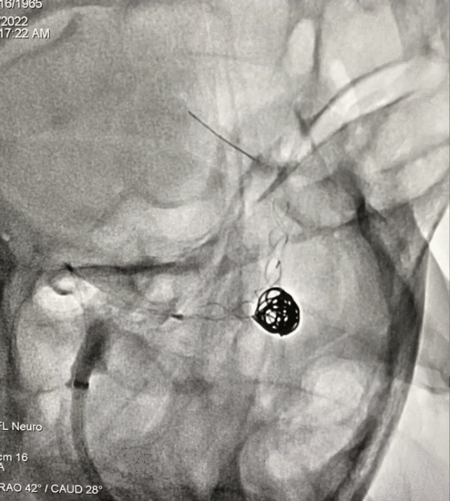 什么达医畅疗·第一期 ｜ 畅医达（Choydar）17小系统血流导向装置治疗大脑中动脉动脉瘤两例_https://www.jmylbn.com_新闻资讯_第17张