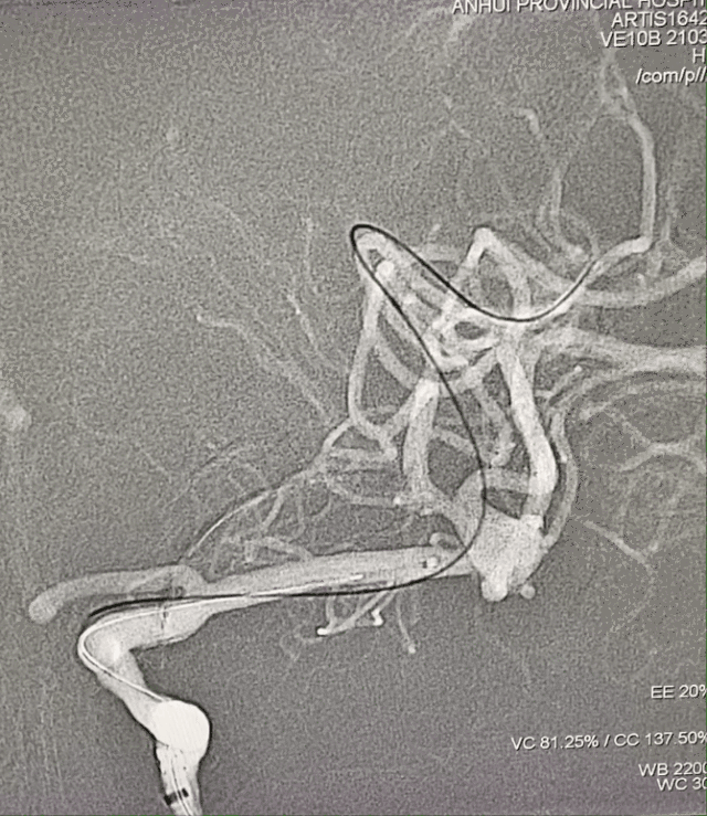 什么达医畅疗·第一期 ｜ 畅医达（Choydar）17小系统血流导向装置治疗大脑中动脉动脉瘤两例_https://www.jmylbn.com_新闻资讯_第12张