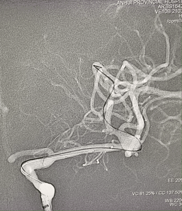 什么达医畅疗·第一期 ｜ 畅医达（Choydar）17小系统血流导向装置治疗大脑中动脉动脉瘤两例_https://www.jmylbn.com_新闻资讯_第11张