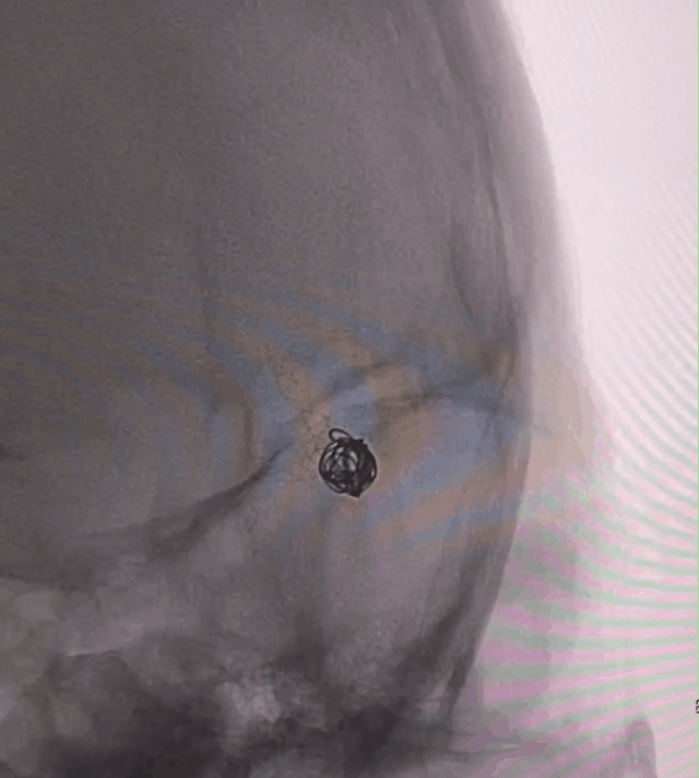 什么达医畅疗·第一期 ｜ 畅医达（Choydar）17小系统血流导向装置治疗大脑中动脉动脉瘤两例_https://www.jmylbn.com_新闻资讯_第19张