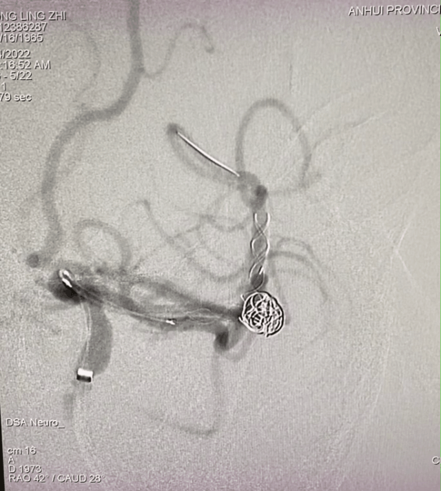 什么达医畅疗·第一期 ｜ 畅医达（Choydar）17小系统血流导向装置治疗大脑中动脉动脉瘤两例_https://www.jmylbn.com_新闻资讯_第16张