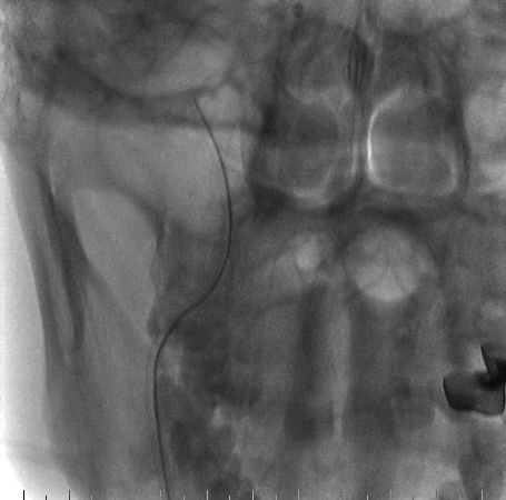 什么达医畅疗·第二期 ｜ 畅医达（Choydar）17小系统血流导向装置经桡治疗大脑中动脉动脉瘤_https://www.jmylbn.com_新闻资讯_第40张
