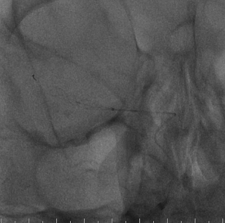 什么达医畅疗·第二期 ｜ 畅医达（Choydar）17小系统血流导向装置经桡治疗大脑中动脉动脉瘤_https://www.jmylbn.com_新闻资讯_第47张