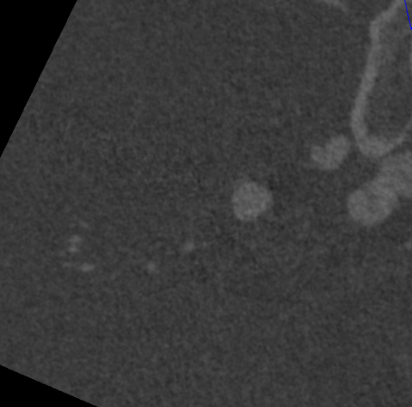 什么达医畅疗·第二期 ｜ 畅医达（Choydar）17小系统血流导向装置经桡治疗大脑中动脉动脉瘤_https://www.jmylbn.com_新闻资讯_第52张