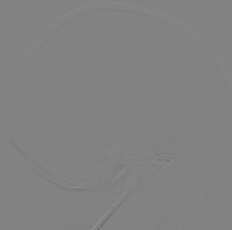 什么达医畅疗·第二期 ｜ 畅医达（Choydar）17小系统血流导向装置经桡治疗大脑中动脉动脉瘤_https://www.jmylbn.com_新闻资讯_第54张