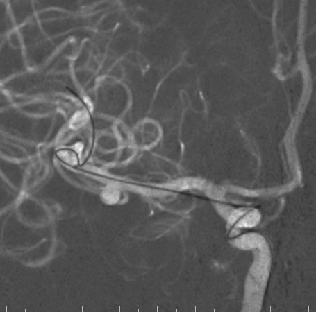 什么达医畅疗·第二期 ｜ 畅医达（Choydar）17小系统血流导向装置经桡治疗大脑中动脉动脉瘤_https://www.jmylbn.com_新闻资讯_第42张