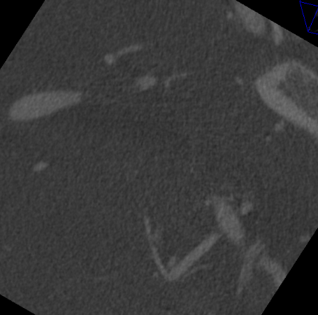 什么达医畅疗·第二期 ｜ 畅医达（Choydar）17小系统血流导向装置经桡治疗大脑中动脉动脉瘤_https://www.jmylbn.com_新闻资讯_第51张