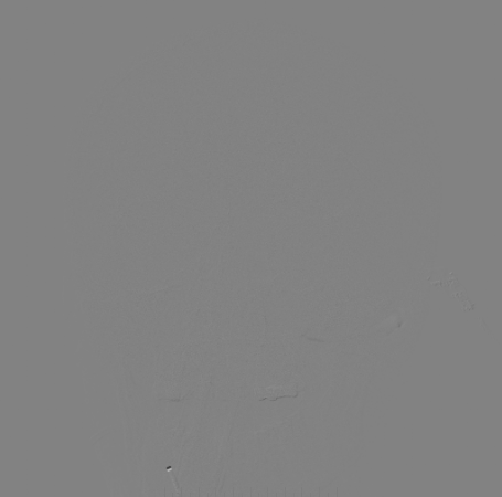 什么达医畅疗·第二期 ｜ 畅医达（Choydar）17小系统血流导向装置经桡治疗大脑中动脉动脉瘤_https://www.jmylbn.com_新闻资讯_第55张