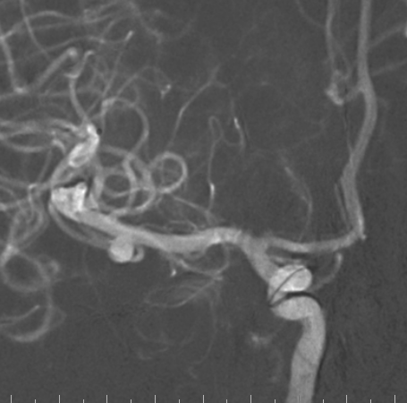什么达医畅疗·第二期 ｜ 畅医达（Choydar）17小系统血流导向装置经桡治疗大脑中动脉动脉瘤_https://www.jmylbn.com_新闻资讯_第43张