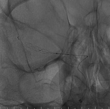 什么达医畅疗·第二期 ｜ 畅医达（Choydar）17小系统血流导向装置经桡治疗大脑中动脉动脉瘤_https://www.jmylbn.com_新闻资讯_第46张