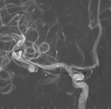 什么达医畅疗·第二期 ｜ 畅医达（Choydar）17小系统血流导向装置经桡治疗大脑中动脉动脉瘤_https://www.jmylbn.com_新闻资讯_第44张