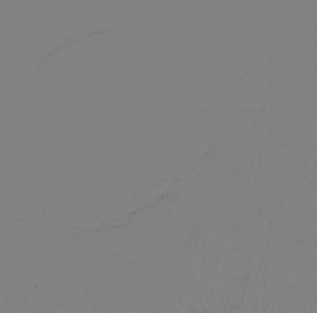 什么达医畅疗·第二期 ｜ 畅医达（Choydar）17小系统血流导向装置经桡治疗大脑中动脉动脉瘤_https://www.jmylbn.com_新闻资讯_第48张