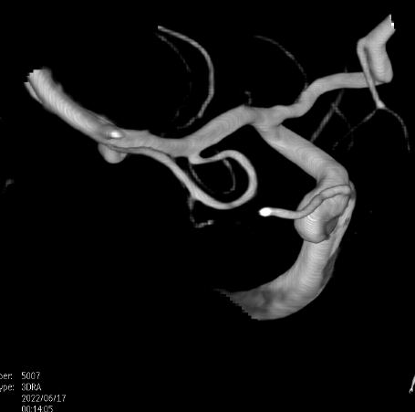 什么达医畅疗·第二期 ｜ 畅医达（Choydar）17小系统血流导向装置经桡治疗大脑中动脉动脉瘤_https://www.jmylbn.com_新闻资讯_第25张