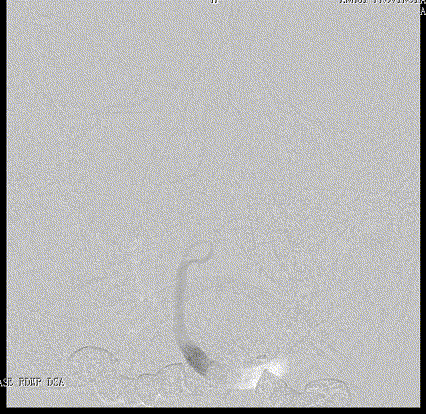 什么达医畅疗·第五期 ｜ 畅医达17小系统动脉瘤辅助支架治疗基底动脉尖不规则宽颈动脉瘤_https://www.jmylbn.com_新闻资讯_第9张