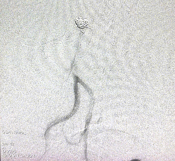 什么达医畅疗·第五期 ｜ 畅医达17小系统动脉瘤辅助支架治疗基底动脉尖不规则宽颈动脉瘤_https://www.jmylbn.com_新闻资讯_第27张