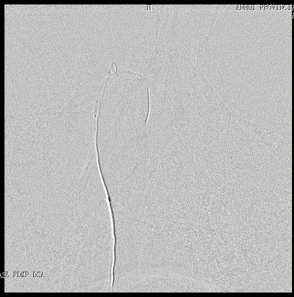 什么达医畅疗·第五期 ｜ 畅医达17小系统动脉瘤辅助支架治疗基底动脉尖不规则宽颈动脉瘤_https://www.jmylbn.com_新闻资讯_第20张