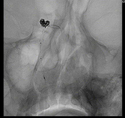 什么达医畅疗·第五期 ｜ 畅医达17小系统动脉瘤辅助支架治疗基底动脉尖不规则宽颈动脉瘤_https://www.jmylbn.com_新闻资讯_第24张
