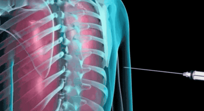 穿刺活检枪怎么用一个真实病例，带您认识肿瘤内科的“神枪手”与经皮肺穿刺活检术_https://www.jmylbn.com_新闻资讯_第1张