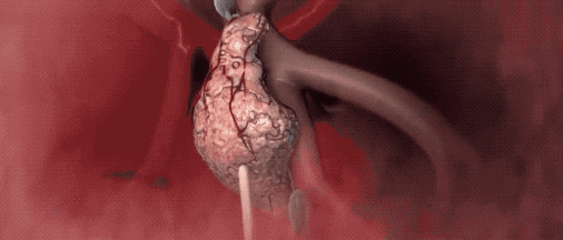 穿刺活检枪怎么用一个真实病例，带您认识肿瘤内科的“神枪手”与经皮肺穿刺活检术_https://www.jmylbn.com_新闻资讯_第2张