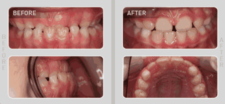 儿童早期矫治&mdash;&mdash;MRC肌功能正畸
