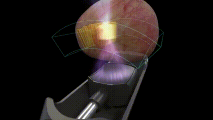 前列腺机器怎么治疗义诊及免费手术招募丨高能聚焦超声机器人即将落地我院，为前列腺增生及前列腺癌患者带来新选择_https://www.jmylbn.com_新闻资讯_第5张
