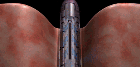 端端吻合器是什么【吻合器简史】谁说只有慢工能出细活？_https://www.jmylbn.com_新闻资讯_第15张