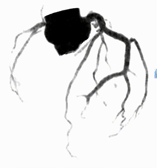 什么是联影ct真香预警？联影医疗双宽体双源CT大揭秘！TA竟然可以看到心脏的高清运动！_https://www.jmylbn.com_新闻资讯_第14张