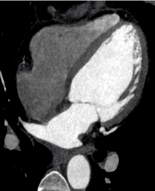 什么是联影ct真香预警？联影医疗双宽体双源CT大揭秘！TA竟然可以看到心脏的高清运动！_https://www.jmylbn.com_新闻资讯_第4张