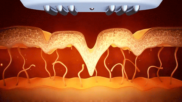 多极射频是什么不花冤枉钱，家用射频美容仪的真相是什么？_https://www.jmylbn.com_新闻资讯_第5张