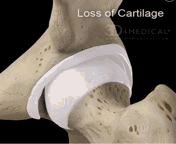 大腿根部疼痛，翘不了二郎腿，是怎么回事