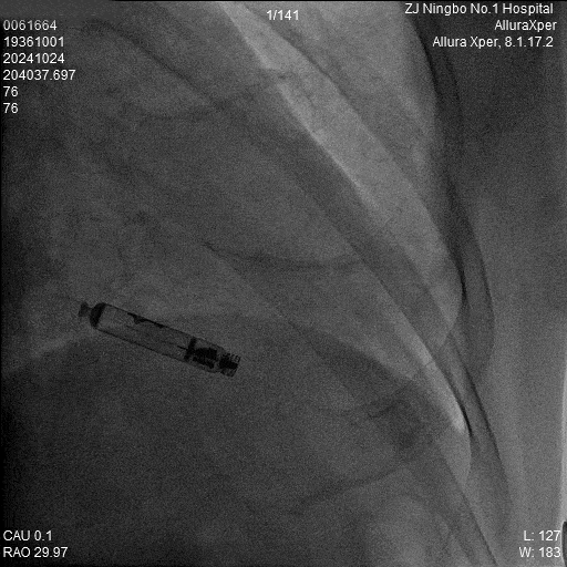 心脏是怎么固定的“螺旋固定，无线心动”——新型主动螺旋固定式无导线心脏起搏器植入术案例分享_https://www.jmylbn.com_新闻资讯_第13张
