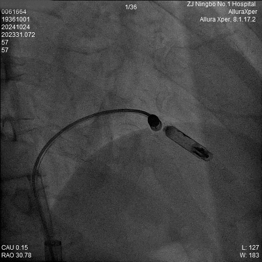 心脏是怎么固定的“螺旋固定，无线心动”——新型主动螺旋固定式无导线心脏起搏器植入术案例分享_https://www.jmylbn.com_新闻资讯_第11张