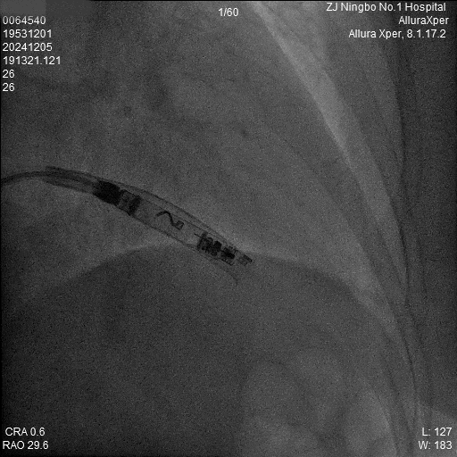 心脏是怎么固定的“螺旋固定，无线心动”——新型主动螺旋固定式无导线心脏起搏器植入术案例分享_https://www.jmylbn.com_新闻资讯_第21张