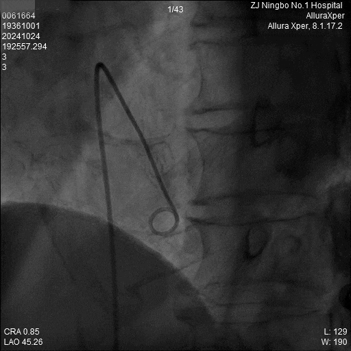 心脏是怎么固定的“螺旋固定，无线心动”——新型主动螺旋固定式无导线心脏起搏器植入术案例分享_https://www.jmylbn.com_新闻资讯_第5张