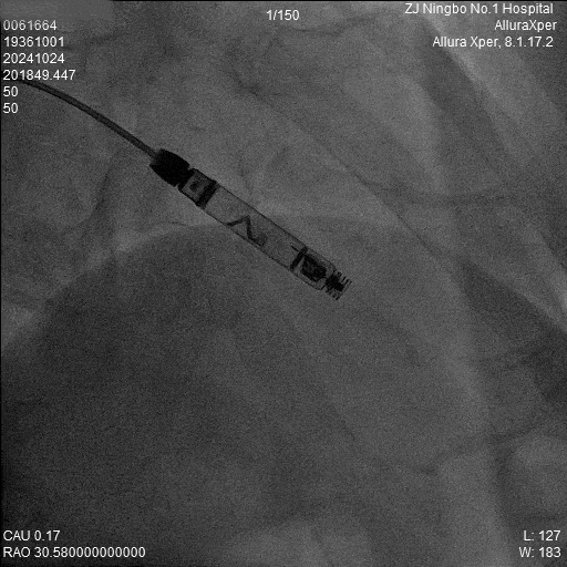 心脏是怎么固定的“螺旋固定，无线心动”——新型主动螺旋固定式无导线心脏起搏器植入术案例分享_https://www.jmylbn.com_新闻资讯_第9张
