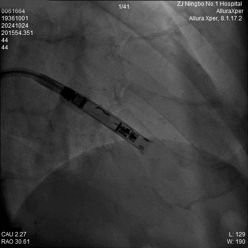 心脏是怎么固定的“螺旋固定，无线心动”——新型主动螺旋固定式无导线心脏起搏器植入术案例分享_https://www.jmylbn.com_新闻资讯_第7张