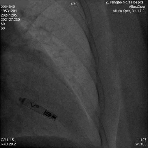 心脏是怎么固定的“螺旋固定，无线心动”——新型主动螺旋固定式无导线心脏起搏器植入术案例分享_https://www.jmylbn.com_新闻资讯_第23张