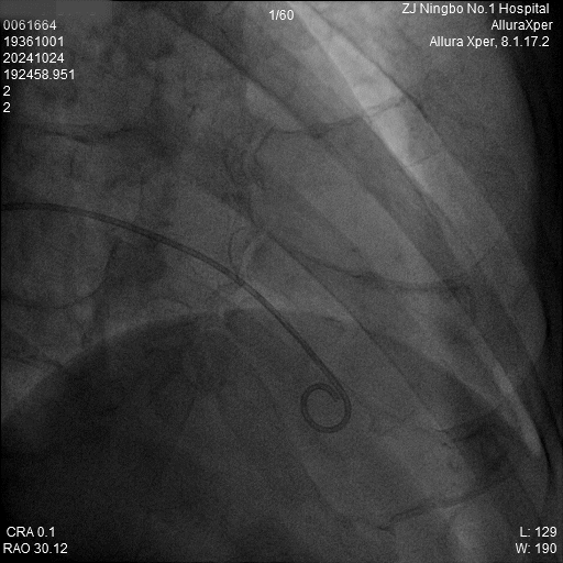心脏是怎么固定的“螺旋固定，无线心动”——新型主动螺旋固定式无导线心脏起搏器植入术案例分享_https://www.jmylbn.com_新闻资讯_第4张