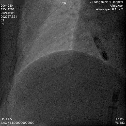 心脏是怎么固定的“螺旋固定，无线心动”——新型主动螺旋固定式无导线心脏起搏器植入术案例分享_https://www.jmylbn.com_新闻资讯_第24张