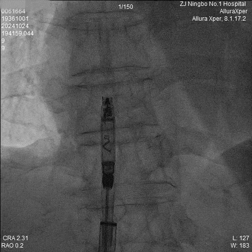 心脏是怎么固定的“螺旋固定，无线心动”——新型主动螺旋固定式无导线心脏起搏器植入术案例分享_https://www.jmylbn.com_新闻资讯_第6张
