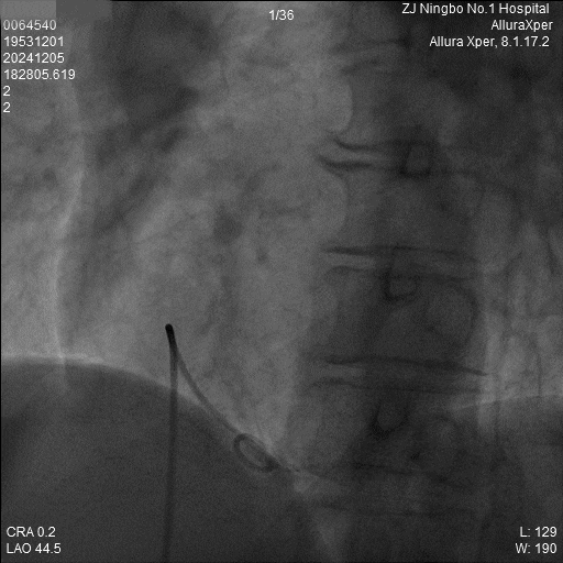 心脏是怎么固定的“螺旋固定，无线心动”——新型主动螺旋固定式无导线心脏起搏器植入术案例分享_https://www.jmylbn.com_新闻资讯_第20张