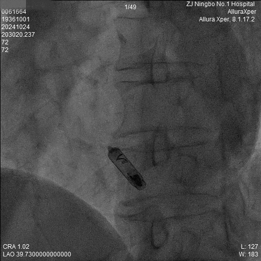 心脏是怎么固定的“螺旋固定，无线心动”——新型主动螺旋固定式无导线心脏起搏器植入术案例分享_https://www.jmylbn.com_新闻资讯_第14张