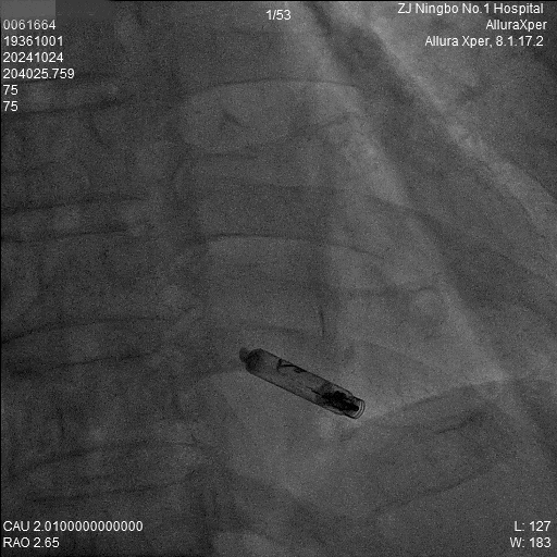 心脏是怎么固定的“螺旋固定，无线心动”——新型主动螺旋固定式无导线心脏起搏器植入术案例分享_https://www.jmylbn.com_新闻资讯_第12张