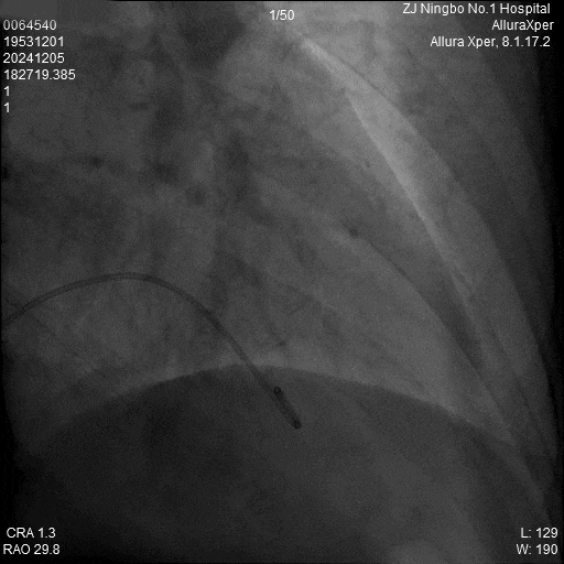 心脏是怎么固定的“螺旋固定，无线心动”——新型主动螺旋固定式无导线心脏起搏器植入术案例分享_https://www.jmylbn.com_新闻资讯_第19张