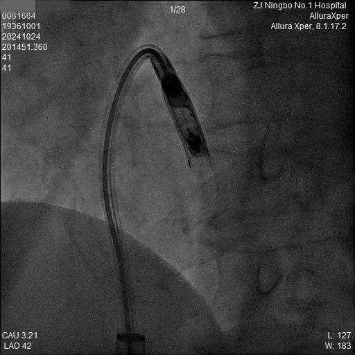 心脏是怎么固定的“螺旋固定，无线心动”——新型主动螺旋固定式无导线心脏起搏器植入术案例分享_https://www.jmylbn.com_新闻资讯_第8张